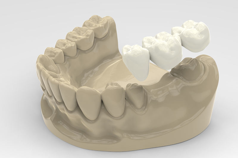 dental bridges 3d rendering