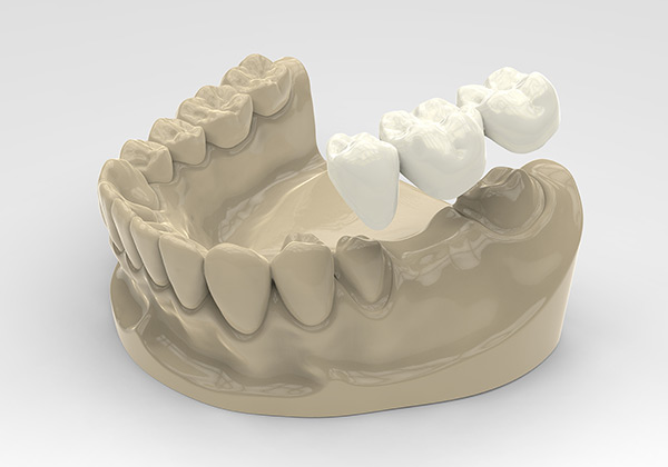 dental bridges process model