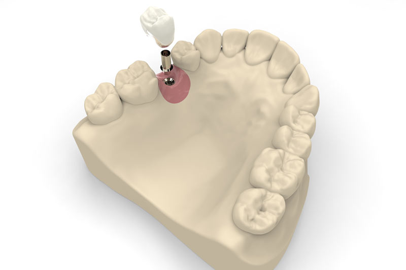 dentist looking at xray of missing teeth