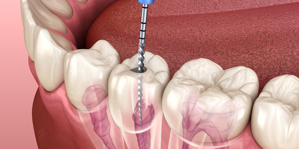 Endodontic root canal treatment process. Medically accurate toot