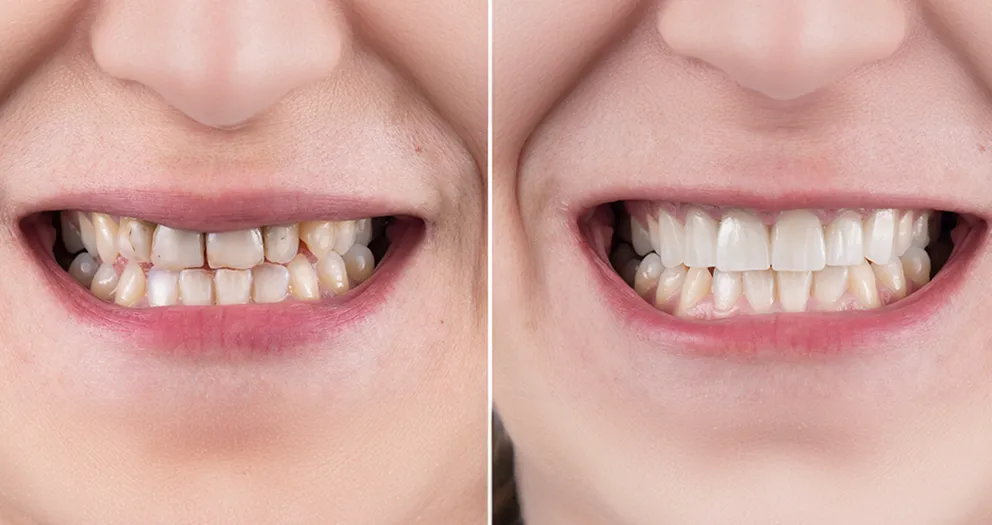 dental veneers before and after