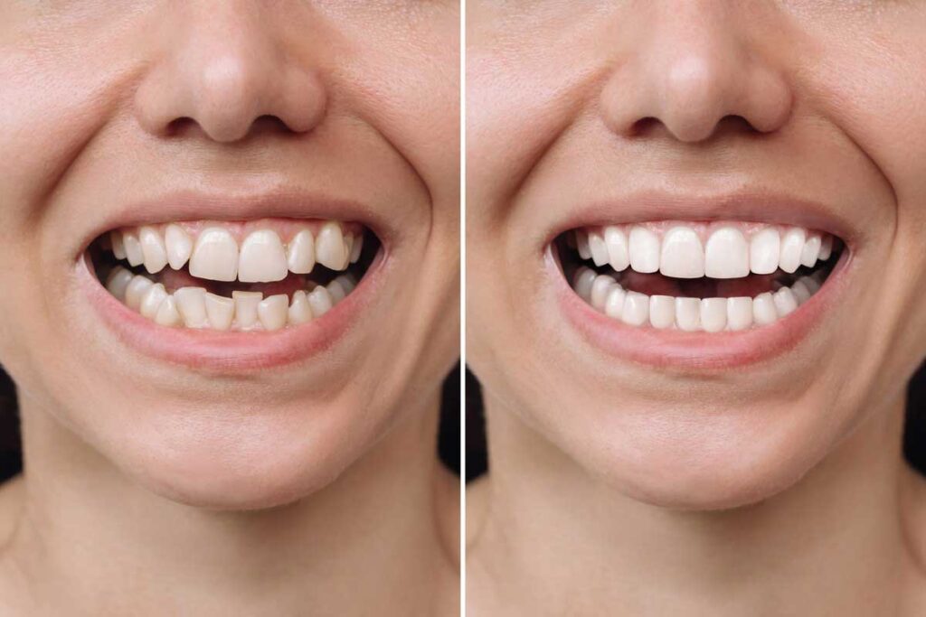 invisalign before and after crowding