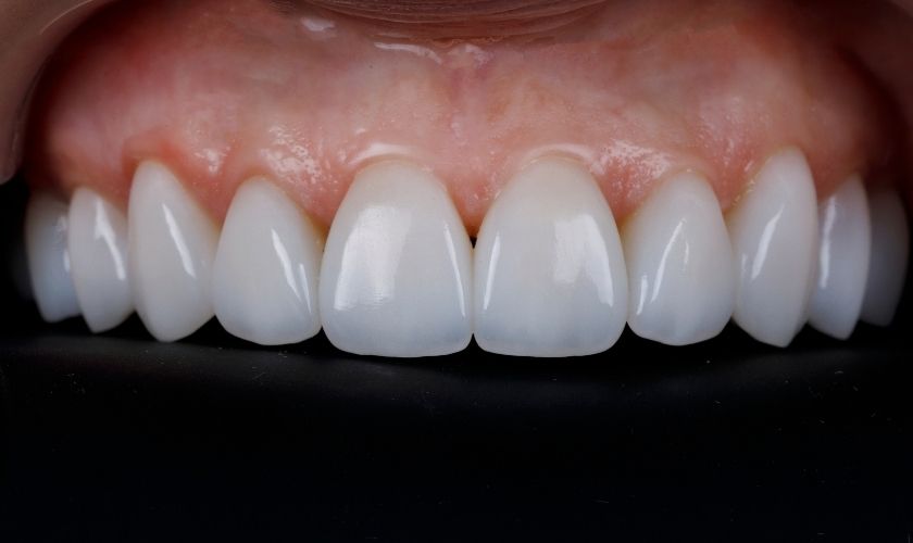 maintenance tips for porcelain veneers