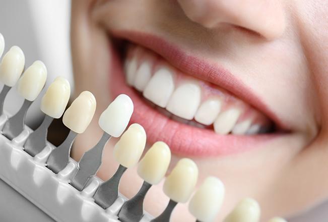 porcelain veneers sana-dental general dental clinic