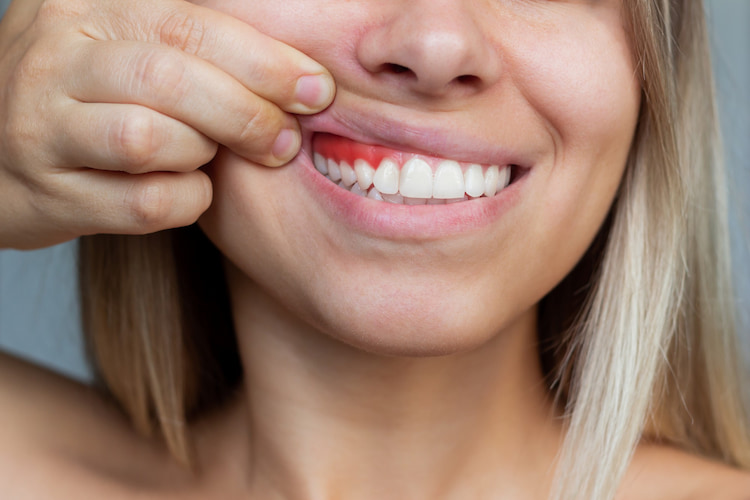 Gum inflammation closeup of a young woman showing bleeding gums on a gray background dentistry.