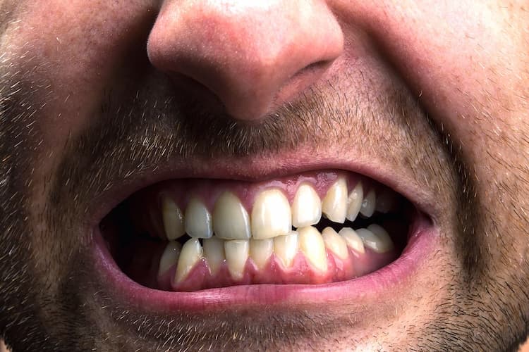 close-up of a man who is severely grinding his teeth. 