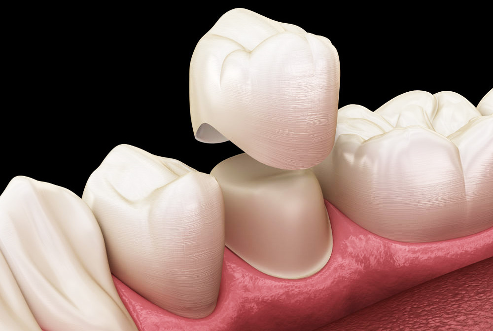 CEREC Crowns