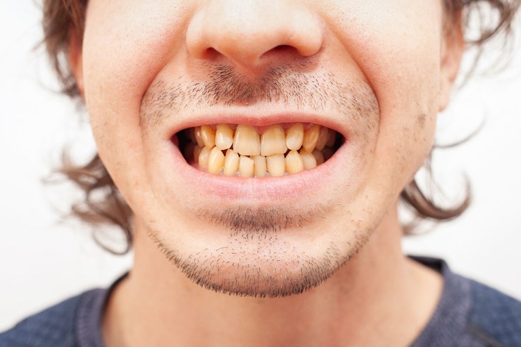 Close-up of a man’s yellow, stained teeth.