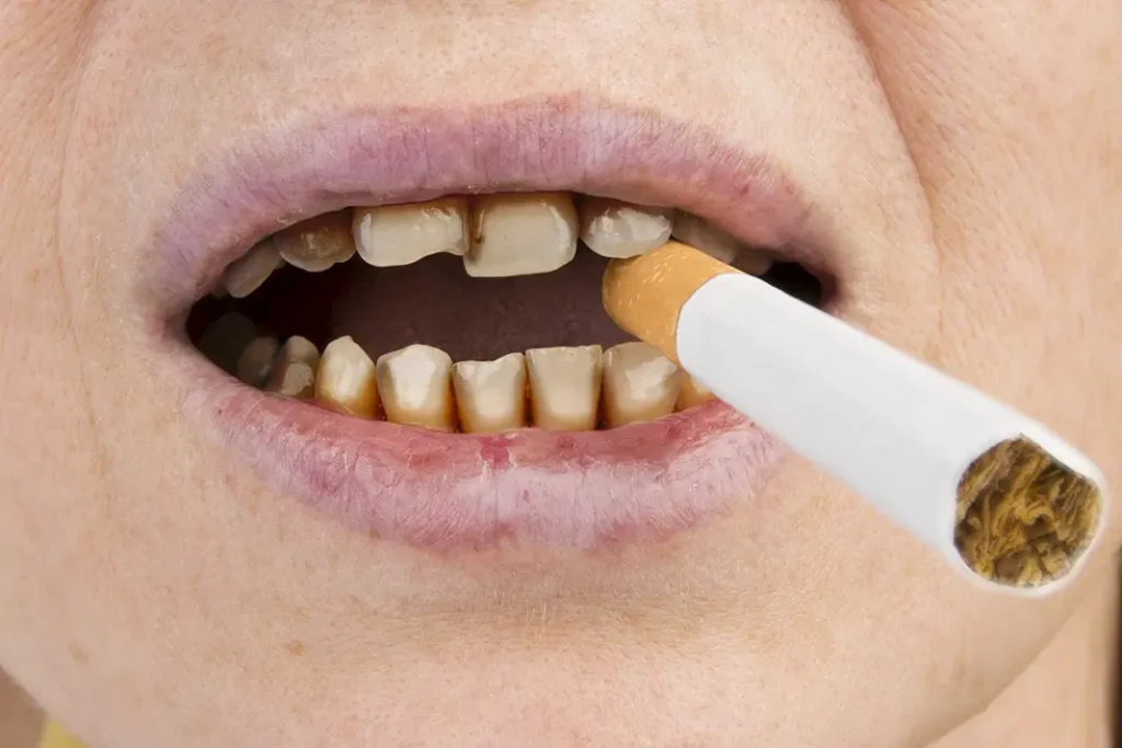 how smoking affects dental hygiene