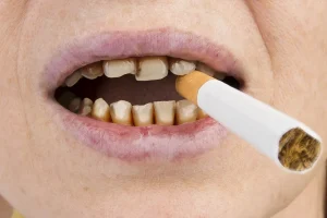 how smoking affects dental hygiene