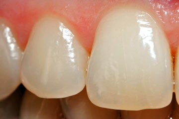 Toronto's coffee culture effect on your teeth: enamel wear