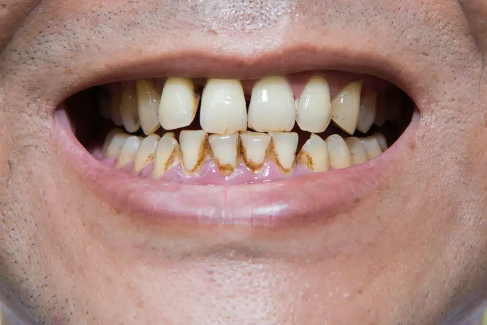 how smoking affects dental hygiene