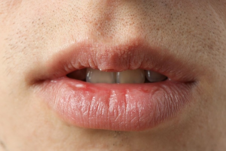 Close-up of a person’s lips and mouth showing signs of dry mouth (xerostomia)