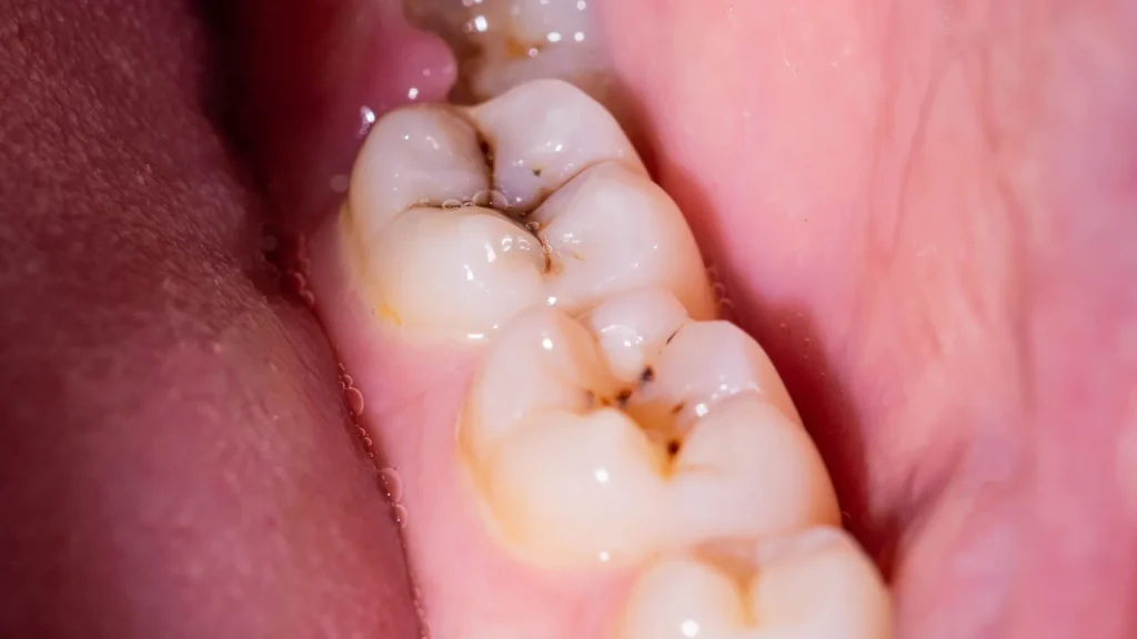 Toronto's coffee culture effect on your teeth: tooth decay