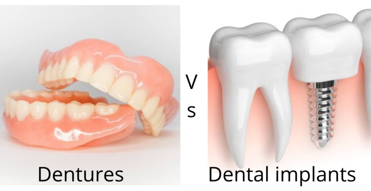 Vector illustration of dentures vs implants with their names below them