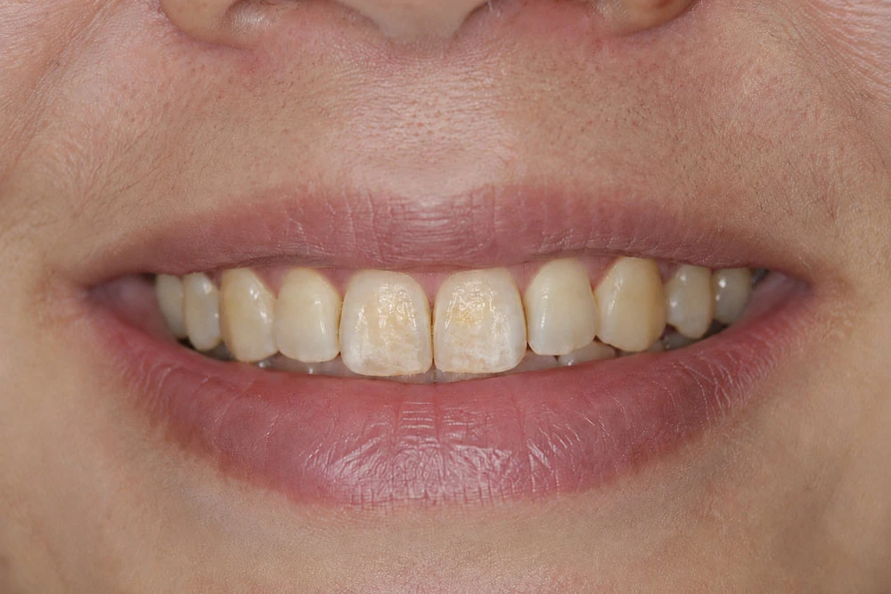 Are You a Candidate for Teeth Whitening?