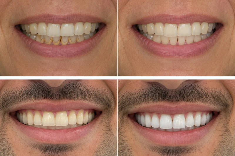 Dental Cleaning vs Teeth Whitening
