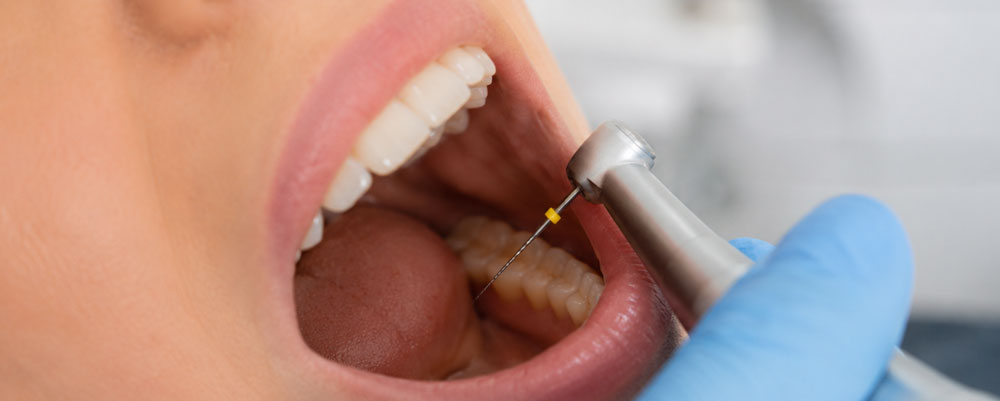 Pain-Free Root Canal Therapy in Toronto​