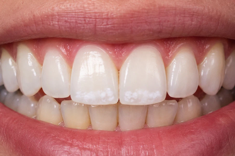 White-Spots-After-Whitening,-Normal-or-Not