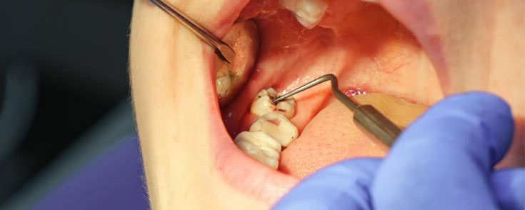 Wisdom Teeth Removal