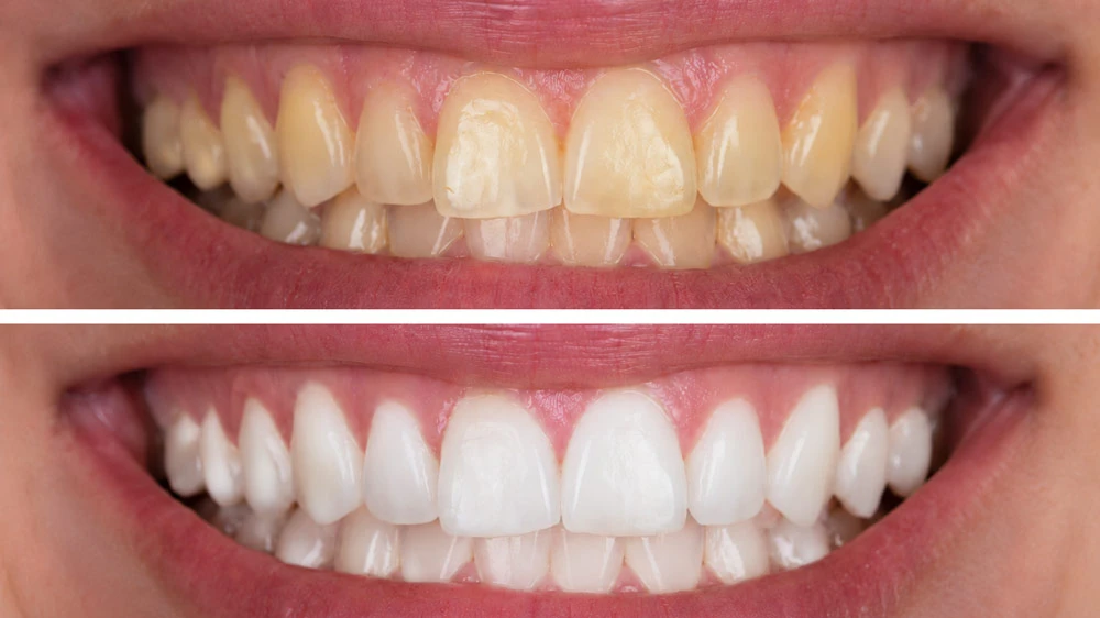 before-after-Teeth-Whitening-in-Toronto---park-dental-center