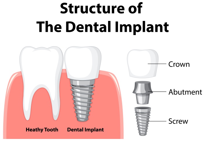 Vector illustration of a dental implant with its different parts labeled.