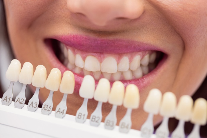 A close-up of a row of porcelain veneers held in front of a smiling woman's teeth for comparison.