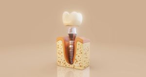 A graphic mockup of a tooth with a dental implant embedded in the gum.