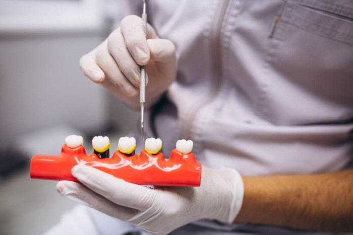 A row of dental implants in a male dentist's hands, while he points to them with another instrument and explains them.