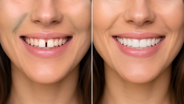 A digital smile preview showing the patient's expected teeth after porcelain veneers, helping her visualize the final result and make a better decision about porcelain veneers cost in Toronto.