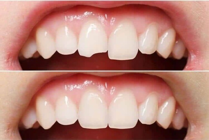 A before-and-after comparison of a patient's smile after dental bonding treatment