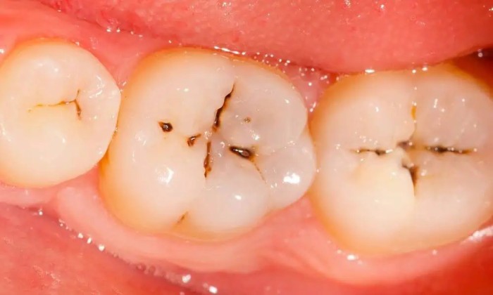A close-up of black spots on teeth appearing on the molars