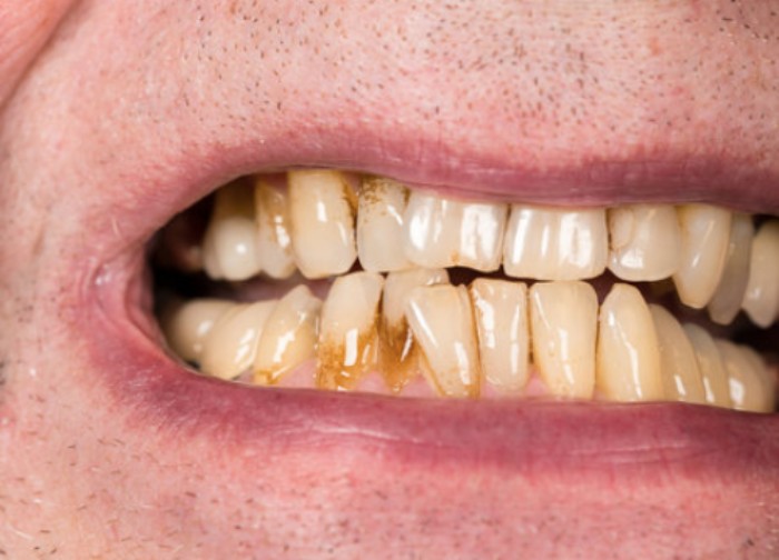 A close-up of black spots on teeth appearing as yellow stains on the front teeth