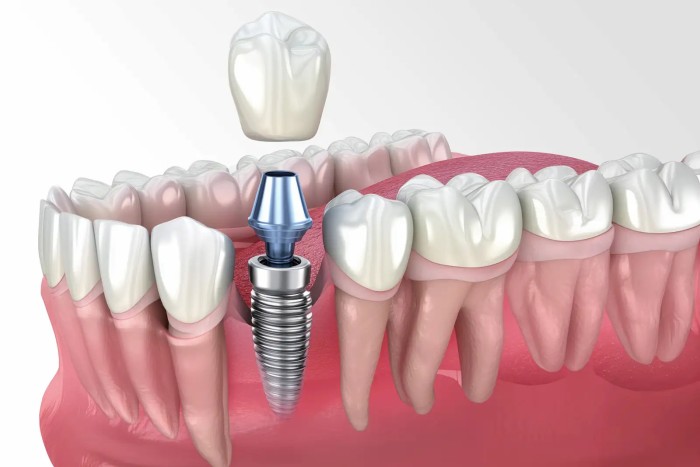 A vector illustration showing the dental implant components placed and stabilized over time: implant first, followed by the abutment and crown