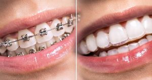 A close-up of Invisalign vs braces in two mouths side by side.