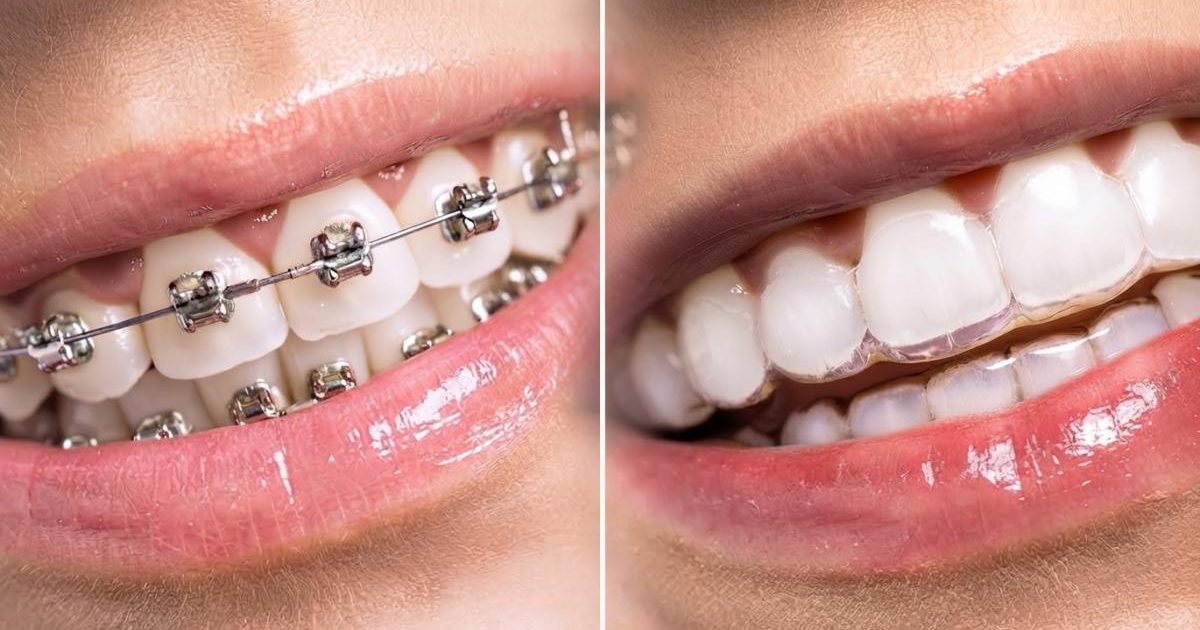 A close-up of Invisalign vs braces in two mouths side by side.