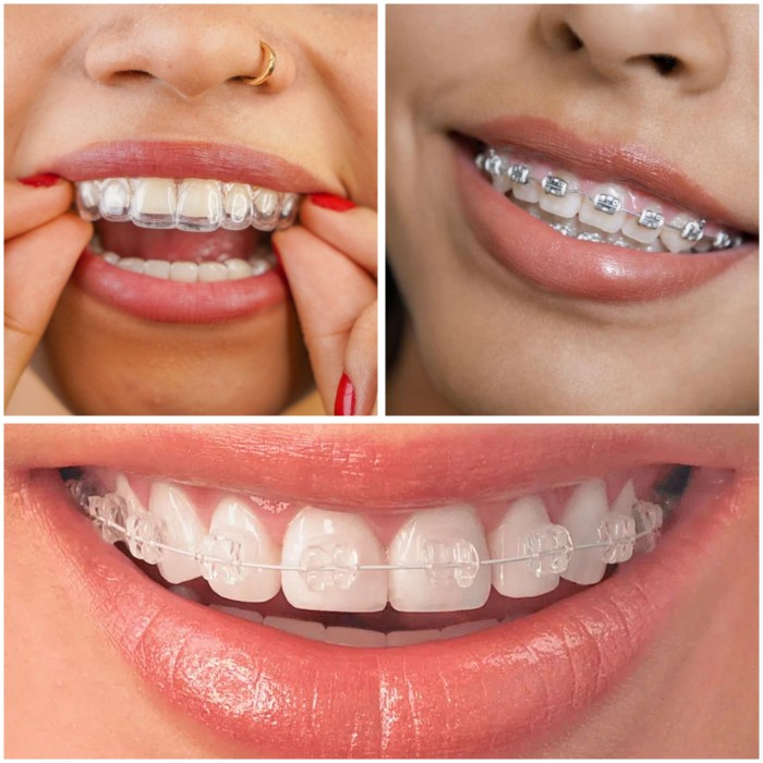A three-panel image showing Invisalign vs. traditional braces vs. ceramic braces.