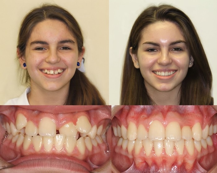 Before-and-after orthodontic treatment with braces.