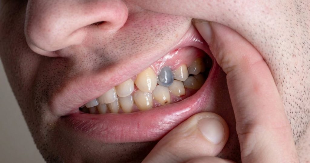 Close-up of a man’s mouth as he lifts his upper lip with his hand, revealing a visible dead tooth among his back teeth.