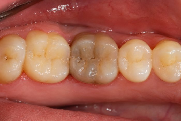 Close-up of the inside of a mouth showing the back teeth, with one darkened tooth suspected to be a dead tooth.
