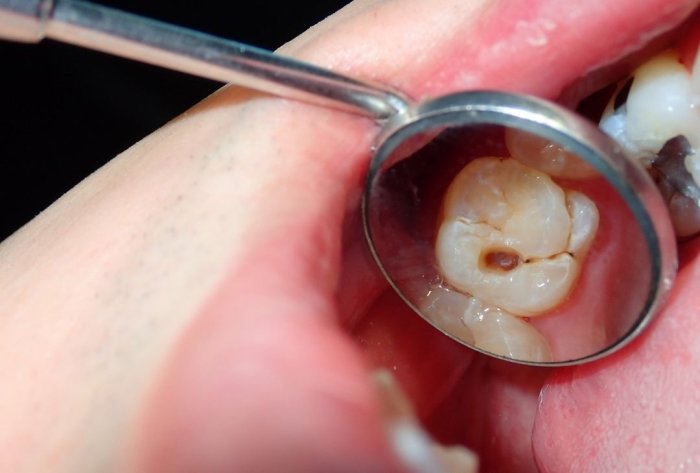 Close-up of a decayed tooth reflected in a small dental mirror, illustrating one of the common causes of a dead tooth.