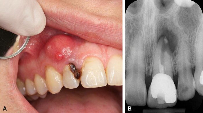 A clinical photograph and X-ray of an untreated dead tooth that has progressed to a periapical abscess.