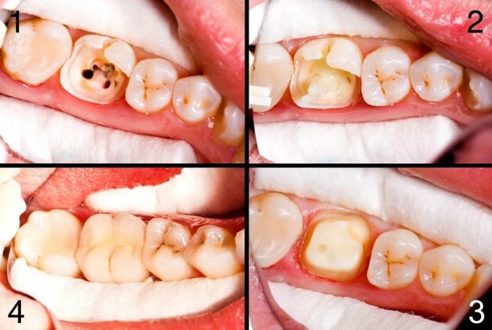 A four-panel image showing the main stages of root canal treatment, one of the primary treatments for a dead tooth.