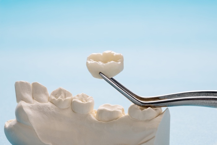 A dental crown being placed over a restored tooth using a dental instrument.