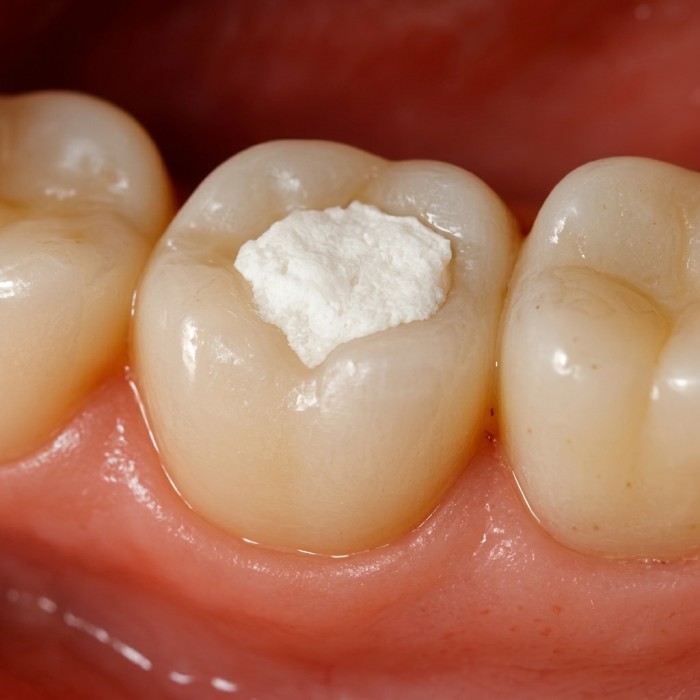 A close-up of over-the-counter temporary dental filling material applied to a lost filling site