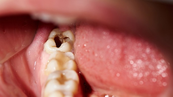 A tooth showing dark discolouration or decay inside after losing its filling