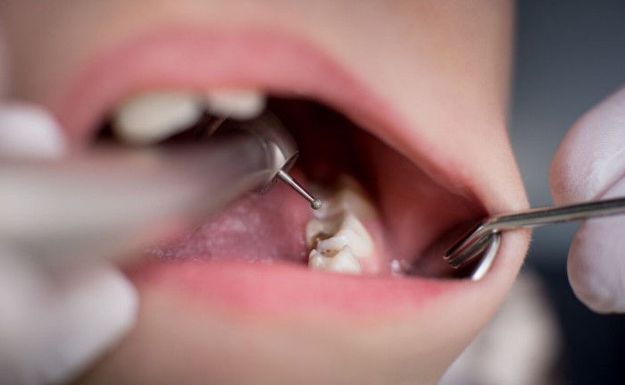 A close-up of a dentist replacing a lost filling for a patient