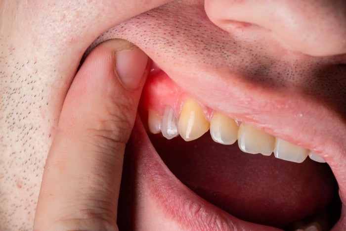 Close-up of a man’s mouth, with his upper lip lifted by his finger to reveal a visible gum boil.