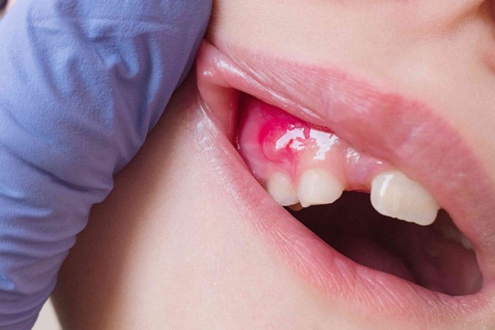 Close-up of a patient’s mouth showing a popped gum boil with pus discharge, while a dentist examines the affected area.